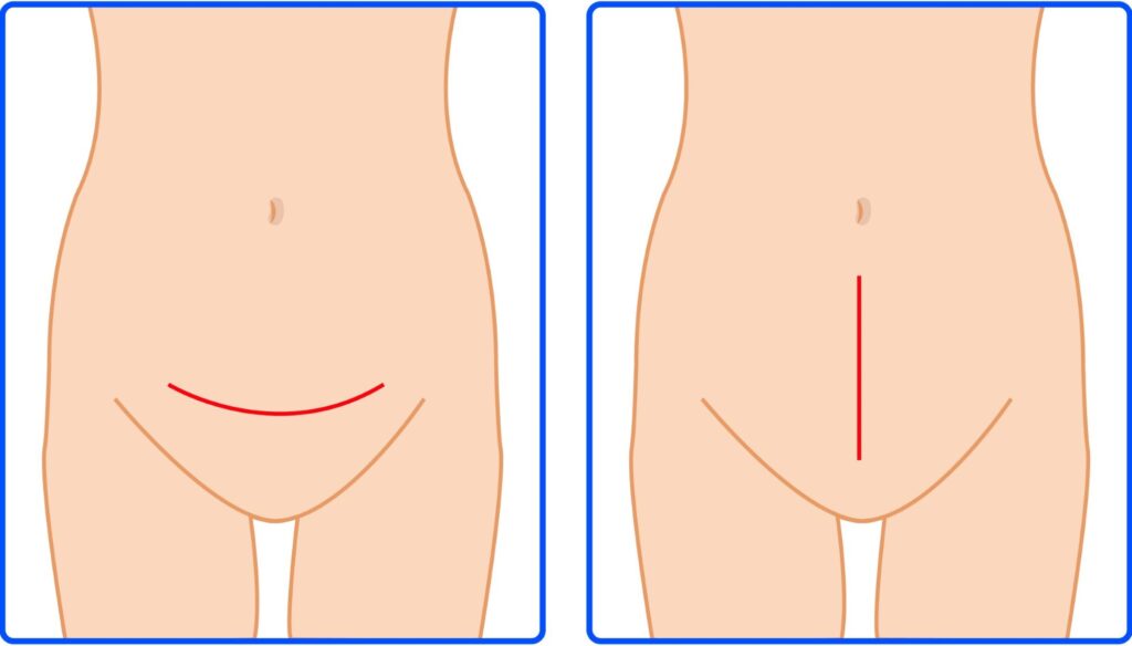 cirurgia abdominal