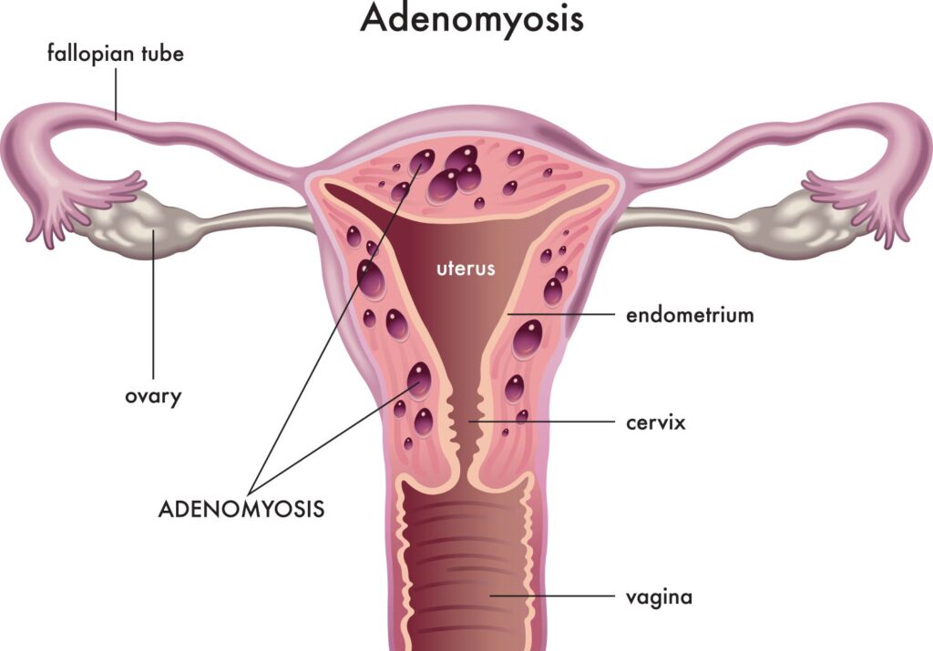 adenomiose