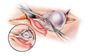 cirurgia para cisto no ovário