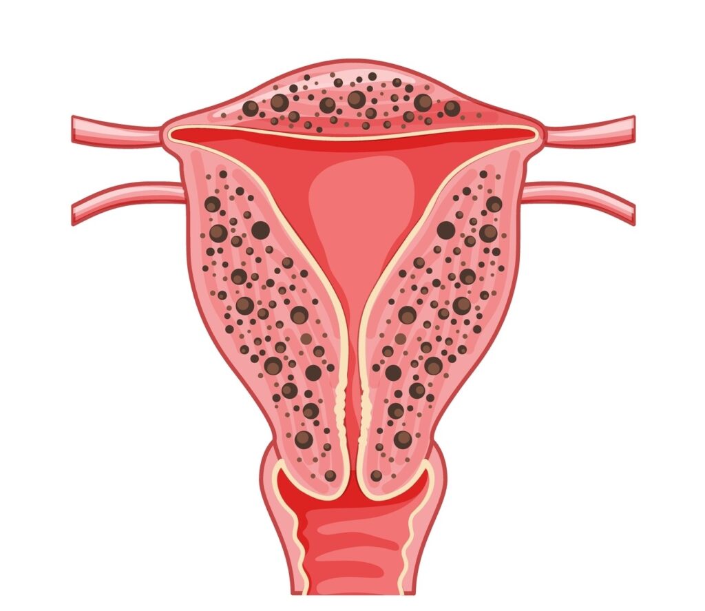 adenomiose