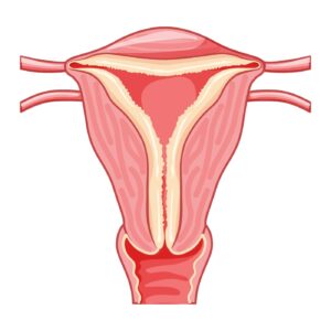 hiperplasia endometrial