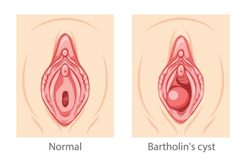 bartholin