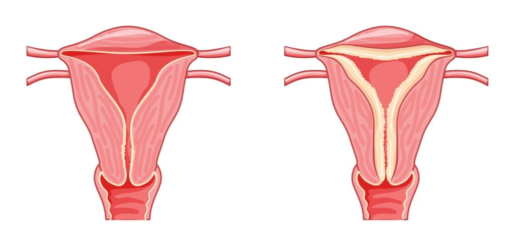 hiperplasia endometrial