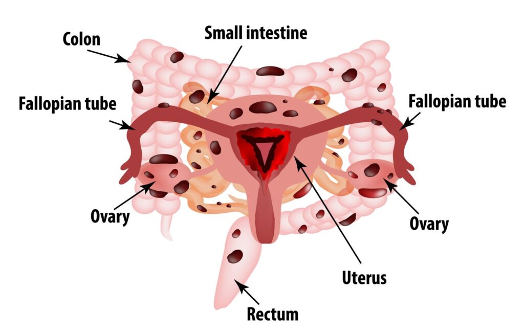 endometriose