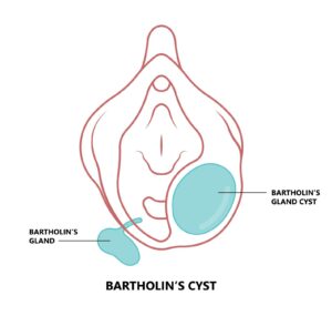 cirurgia a laser do cisto de bartholin