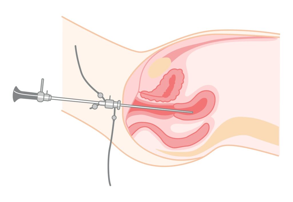 histeroscopia