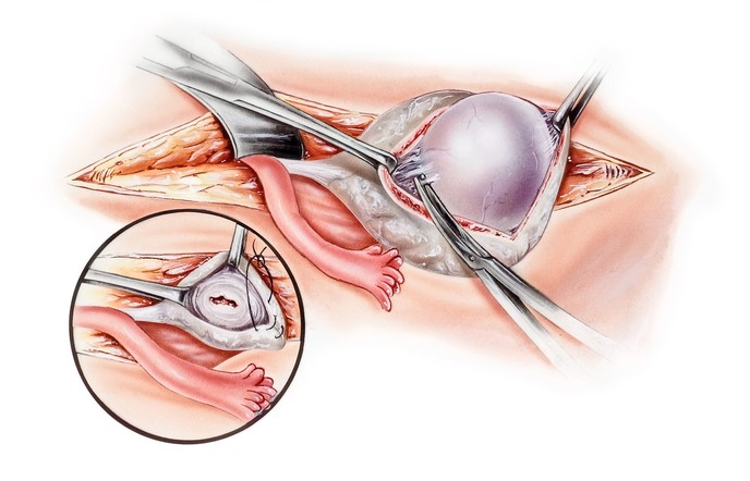 ooforoplastia