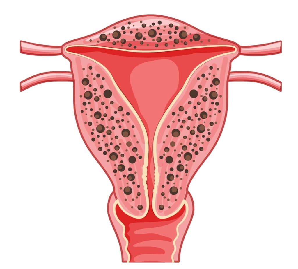 adenomiose