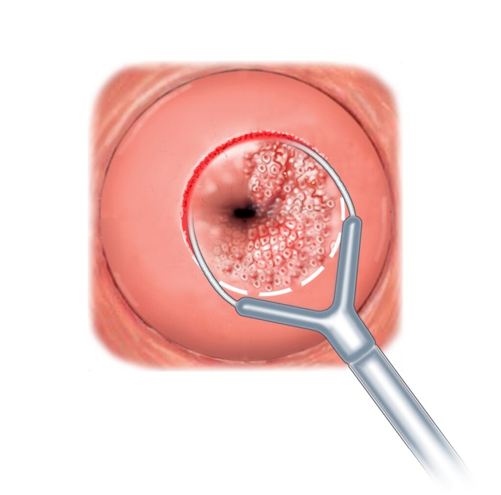 CAF cirurgia de alta frequência