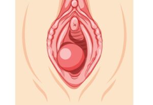 cirurgia do cisto de bartholin