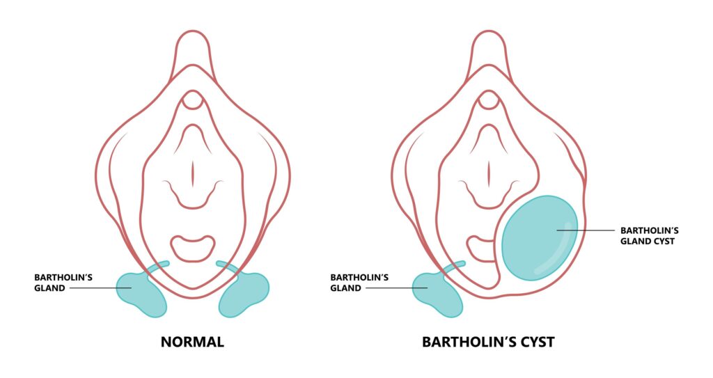 cirurgia do cisto de bartholin