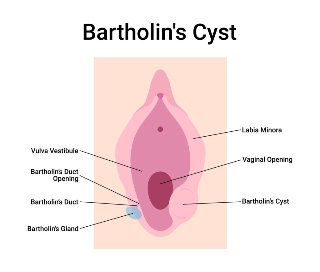 cirurgia do cisto de bartholin