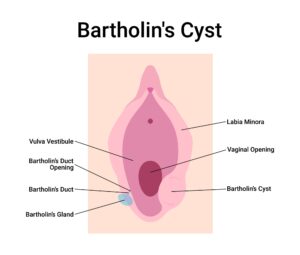 o que é o cisto de bartholin