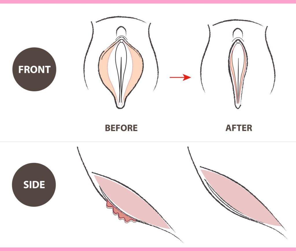 ninfoplastia