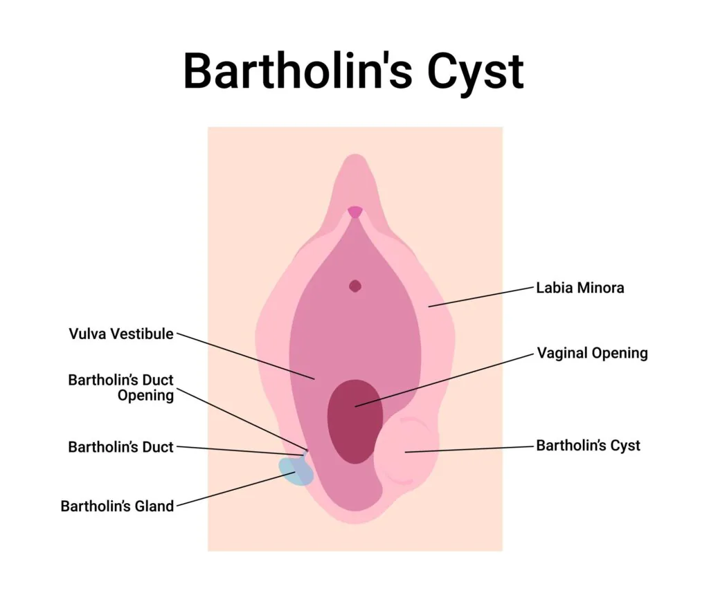 cirurgia do cisto de bartholin